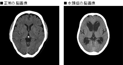 （左）正常の脳画像　（右）水頭症の脳画像