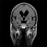 正常圧水頭症のMRI