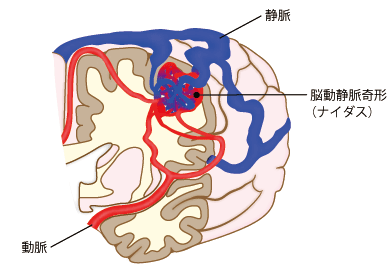 脳動静脈奇形